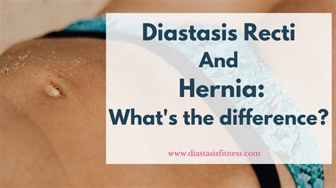 In this case, mesh repairs should be considered. . Diastasis recti and umbilical hernia symptoms